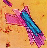 Cristaux de créatine kinase